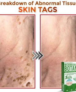 DermaPatchRX® MicroNeedle Botanic Skin Tag Removal Patch