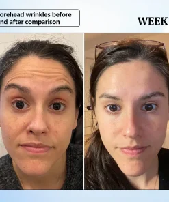 ϹΟRΟU® Nano Microneedle Wrinkle Patch