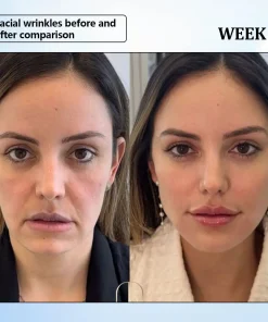 ϹΟRΟU® Nano Microneedle Wrinkle Patch