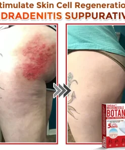 SkinPrikyn™ MicroNeedle Botanic Skin Tag Removal Patch