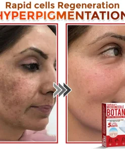 SkinPrikyn™ MicroNeedle Botanic Skin Tag Removal Patch