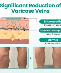 Slimoly™ LegRenew Varicose Veins Patch