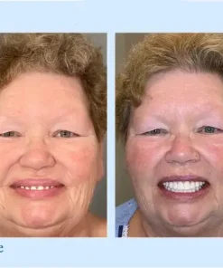 TrueEase™ Custom-Fit Functional Dentures