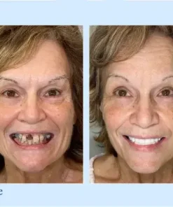 TrueEase™ Custom-Fit Functional Dentures