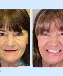 TrueEase™ Custom-Fit Functional Dentures