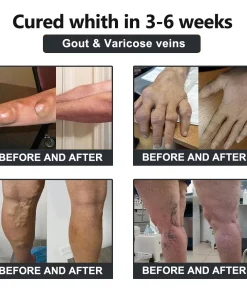 𝐕𝐢𝐨𝐫𝐚𝐥𝐢𝐟𝐞𝐬™ 𝐁𝐞𝐞 𝐕𝐞𝐧𝐨𝐦 𝐚𝐧𝐝 𝐓𝐮𝐫𝐦𝐞𝐫𝐢𝐜 𝐉𝐨𝐢𝐧𝐭 𝐚𝐧𝐝 𝐁𝐨𝐧𝐞 𝐏𝐚𝐢𝐧 𝐑𝐞𝐥𝐢𝐞𝐟 𝐂𝐫𝐞𝐚𝐦