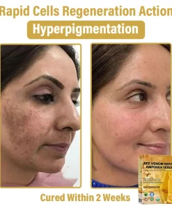 𝐃𝒚𝐜𝐞𝐜𝐨® 𝑩𝒆𝐞 𝑽𝐞𝒏𝒐𝒎 𝑺𝒌𝒊𝒏 𝑹𝐞𝒑𝒂𝒊𝒓 𝑨𝒎𝒑𝒐𝒖𝒍𝐞 𝑺𝐞𝒓𝒖𝒎