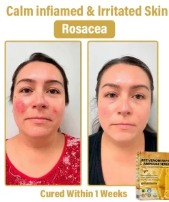 𝐃𝒚𝐜𝐞𝐜𝐨® 𝑩𝒆𝐞 𝑽𝐞𝒏𝒐𝒎 𝑺𝒌𝒊𝒏 𝑹𝐞𝒑𝒂𝒊𝒓 𝑨𝒎𝒑𝒐𝒖𝒍𝐞 𝑺𝐞𝒓𝒖𝒎