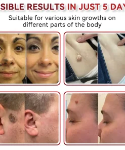 𝑉𝑠𝑜𝑥𝑎® 𝑀𝑖𝑐𝑟𝑜𝑛𝑒𝑒𝑑𝑙𝑒𝑠 𝐵𝑜𝑡𝑎𝑛𝑖𝑐 𝑆𝑘𝑖𝑛 𝑇𝑎𝑔𝑠 𝑆𝑜𝑙𝑢𝑡𝑖𝑜𝑛 𝑃𝑎𝑡𝑐ℎ𝑒𝑠