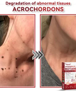 𝑉𝑠𝑜𝑥𝑎® 𝑀𝑖𝑐𝑟𝑜𝑛𝑒𝑒𝑑𝑙𝑒𝑠 𝐵𝑜𝑡𝑎𝑛𝑖𝑐 𝑆𝑘𝑖𝑛 𝑇𝑎𝑔𝑠 𝑆𝑜𝑙𝑢𝑡𝑖𝑜𝑛 𝑃𝑎𝑡𝑐ℎ𝑒𝑠