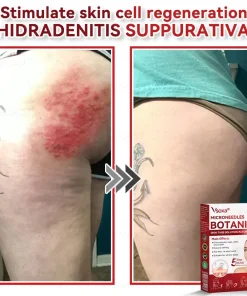 𝑉𝑠𝑜𝑥𝑎® 𝑀𝑖𝑐𝑟𝑜𝑛𝑒𝑒𝑑𝑙𝑒𝑠 𝐵𝑜𝑡𝑎𝑛𝑖𝑐 𝑆𝑘𝑖𝑛 𝑇𝑎𝑔𝑠 𝑆𝑜𝑙𝑢𝑡𝑖𝑜𝑛 𝑃𝑎𝑡𝑐ℎ𝑒𝑠