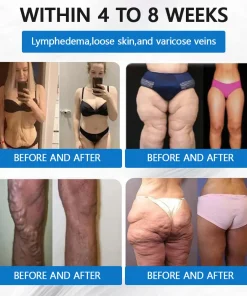 ADFIRE® SMGT-GLP-1 𝐓𝐢𝐫𝐳𝐞𝐩𝐚𝐭𝐢𝐝𝐞 & 𝐂𝐨𝐥𝐥𝐚𝐠𝐞𝐧 𝐍𝐚𝐧𝐨 𝐌𝐢𝐜𝐫𝐨𝐧𝐞𝐞𝐝𝐥𝐞 𝐖𝐞𝐢𝐠𝐡𝐭 𝐋𝐨𝐬𝐬 𝐏𝐚𝐭𝐜𝐡