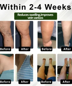 ATTDX® ChestnutEase Edema Massage Herbal Cream