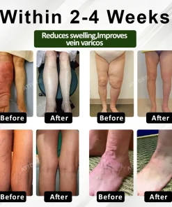 ATTDX® ChestnutEase Edema Massage Herbal Cream