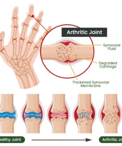 Adfire® Bee Venom Bone & Joint Revive Spray