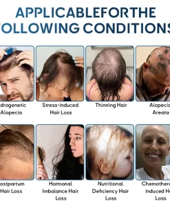 Rolimey® STEM Cell Hair Cycle Roller – Instantly Stops Hair Loss & Promotes Real Regrowth