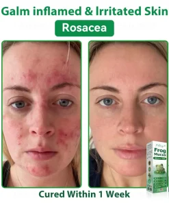 𝐹𝑎𝑡𝑜𝑛𝑔® 𝐹𝑟𝑜𝑔 𝑀𝑢𝑐𝑢𝑠 𝑆𝑘𝑖𝑛 𝑅𝑒𝑝𝑎𝑖𝑟 𝑆𝑝𝑟𝑎𝑦