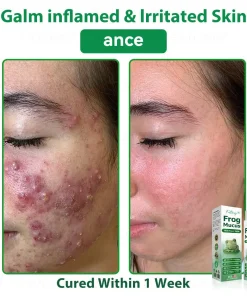 𝐹𝑎𝑡𝑜𝑛𝑔® 𝐹𝑟𝑜𝑔 𝑀𝑢𝑐𝑢𝑠 𝑆𝑘𝑖𝑛 𝑅𝑒𝑝𝑎𝑖𝑟 𝑆𝑝𝑟𝑎𝑦