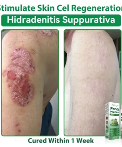 𝐹𝑎𝑡𝑜𝑛𝑔® 𝐹𝑟𝑜𝑔 𝑀𝑢𝑐𝑢𝑠 𝑆𝑘𝑖𝑛 𝑅𝑒𝑝𝑎𝑖𝑟 𝑆𝑝𝑟𝑎𝑦