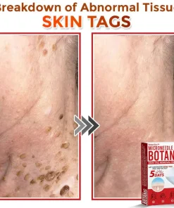 BotaniDot™ MicroNeedle Botanic Skin Tag Removal Patch