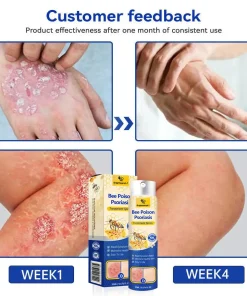Brightmarsh® Bee Poison Psoriasis Treatment Spray