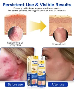 Brightmarsh® Bee Poison Psoriasis Treatment Spray