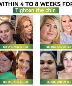 CrazyLeaf® SMGT-GLP-1 Nano Microneedle Patch