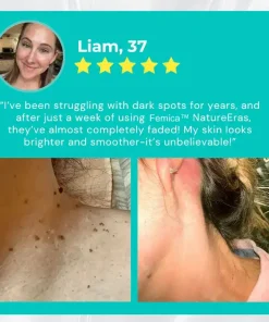 Femica™ NatureErase Instant Mole & Spot Cream