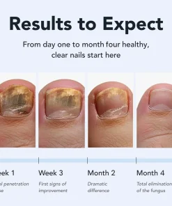 Juxek™ Pro Nail Repair Pen – 25% Undecylenic Acid