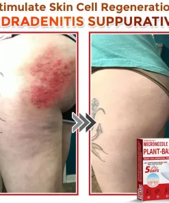 Newyuo® MicroNeedle Botanic Skin Tag Removal Patch