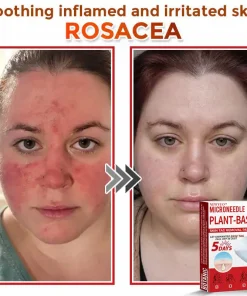 Newyuo® MicroNeedle Botanic Skin Tag Removal Patch