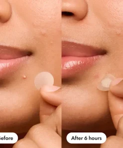 Nexisify™ – Pimple Patch for Clear Skin Overnight (36 Pcs)