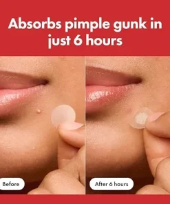 Nexisify™ – Pimple Patch for Clear Skin Overnight (36 Pcs)