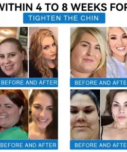 𝐓𝐢𝐫𝐳𝐞𝐩𝐚𝐭𝐢𝐝𝐞 & 𝐂𝐨𝐥𝐥𝐚𝐠𝐞𝐧 𝐍𝐚𝐧𝐨 𝐌𝐢𝐜𝐫𝐨𝐧𝐞𝐞𝐝𝐥𝐞 𝐖𝐞𝐢𝐠𝐡𝐭 𝐋𝐨𝐬𝐬 𝐏𝐚𝐭𝐜𝐡