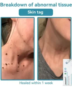 𝐍𝐨𝐧-𝐈𝐧𝐯𝐚𝐬𝐢𝐯𝐞 𝐌𝐨𝐥𝐞 & 𝐖𝐚𝐫𝐭 𝐋𝐚𝐬𝐞𝐫 𝐑𝐞𝐦𝐨𝐯𝐚𝐥 𝐏𝐞𝐧