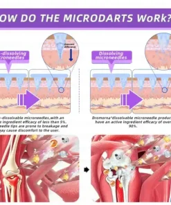 𝑀𝑒𝑔𝑙𝑢𝑡𝑖𝑑𝑒 & 𝐵𝑜𝑡𝑜𝑥 𝑁𝑎𝑛𝑜-𝑚𝑖𝑐𝑟𝑜𝑛𝑒𝑒𝑑𝑙𝑒 𝐽𝑜𝑖𝑛𝑡 𝑃𝑎𝑡𝑐ℎ