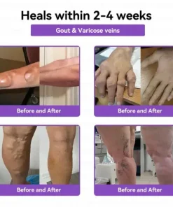 𝑀𝑒𝑔𝑙𝑢𝑡𝑖𝑑𝑒 & 𝐵𝑜𝑡𝑜𝑥 𝑁𝑎𝑛𝑜-𝑚𝑖𝑐𝑟𝑜𝑛𝑒𝑒𝑑𝑙𝑒 𝐽𝑜𝑖𝑛𝑡 𝑃𝑎𝑡𝑐ℎ