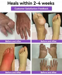 𝑀𝑒𝑔𝑙𝑢𝑡𝑖𝑑𝑒 & 𝐵𝑜𝑡𝑜𝑥 𝑁𝑎𝑛𝑜-𝑚𝑖𝑐𝑟𝑜𝑛𝑒𝑒𝑑𝑙𝑒 𝐽𝑜𝑖𝑛𝑡 𝑃𝑎𝑡𝑐ℎ