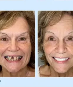 Advanced Customized Full Denture Set