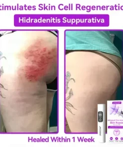 Advanced Non-Invasive Skin Repair CO₂ Laser Pen