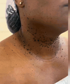 Advanced Non-Invasive Skin Repair CO₂ Laser Pen