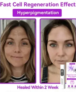 Advanced Non-Invasive Skin Repair CO₂ Laser Pen