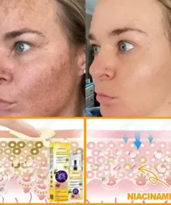 Bee Venom Senile Purpura Cream