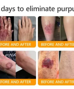 Bee Venom Senile Purpura Cream