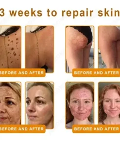 Bee Venom Senile Purpura Cream