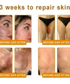 Bee Venom Senile Purpura Cream