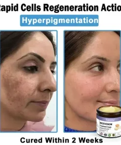 Bee Venom Skin Treatment Cream