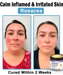 Bee Venom Skin Treatment Cream