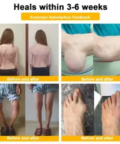 Botulinum Toxin & Bee Venom Pain-Relief Bone Healing Cream