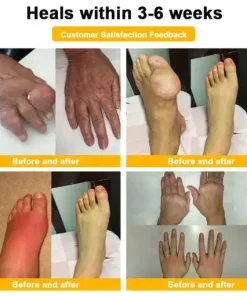 Botulinum Toxin & Bee Venom Pain-Relief Bone Healing Cream